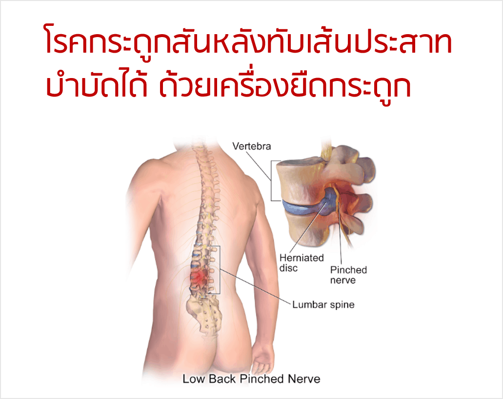 เครื่องยืดกระดูกกับการบำบัดโรคกระดูกสันหลังทับเส้นประสาท |  เทรนด์ดูแลผู้สูงอายุ อุปกรณ์ช่วยเหลือ กายภาพบำบัดศูนย์ทั่วไทย